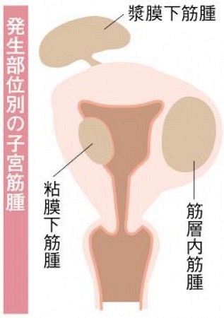 子宮 筋腫 3 センチ